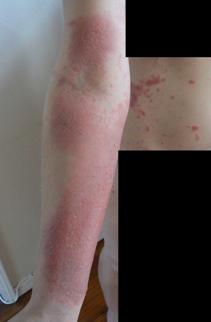 Poison Oak Arm - Kombucha detoxification helped rid my body of remaining toxins
